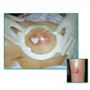 Tegaderm Clear Absorbent Acrylic Dressing 4-2/5" x 5" Oval