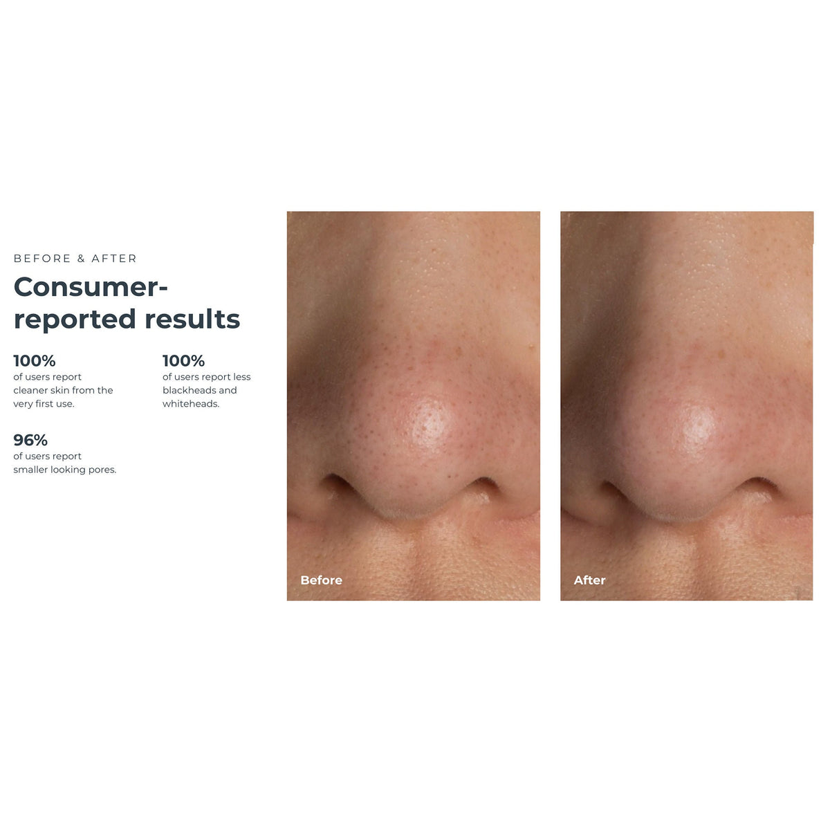 KIWI™ Blackhead Remover Pore Vaccum